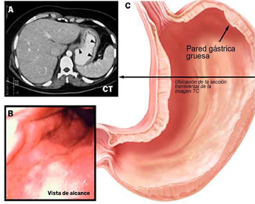 Figura 2: La linitis plástica es característica del carcinoma de tipo difuso.